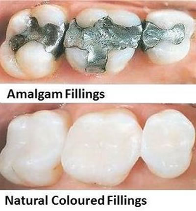 fillings2