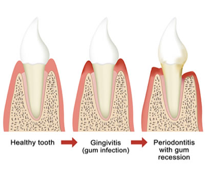 gumdisease1