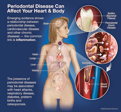 gumdisease2