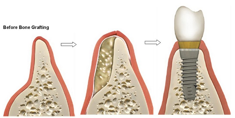 implants3