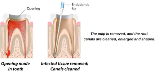 rootcanal2