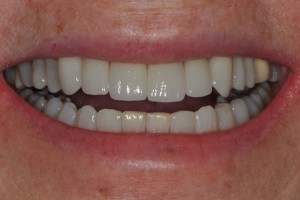 veneers1a