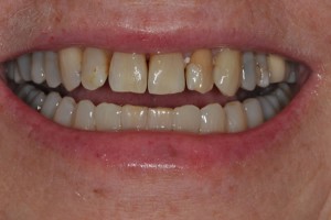 veneers1b