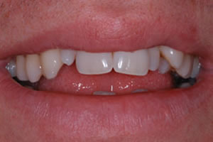 veneers2