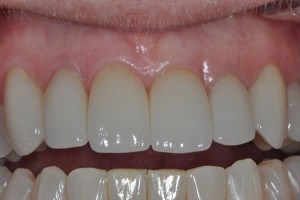 veneers2a