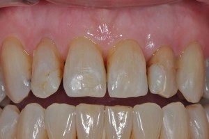 veneers2b