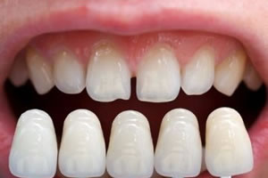 veneers3