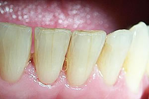 veneers5