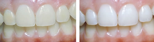 whitening1